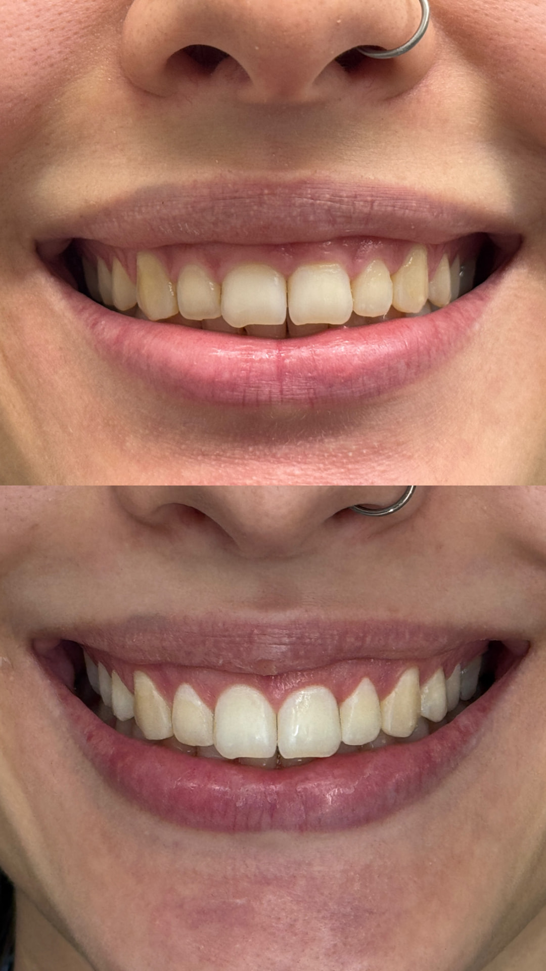 Comparação clínica antes e depois de gengivoplastia