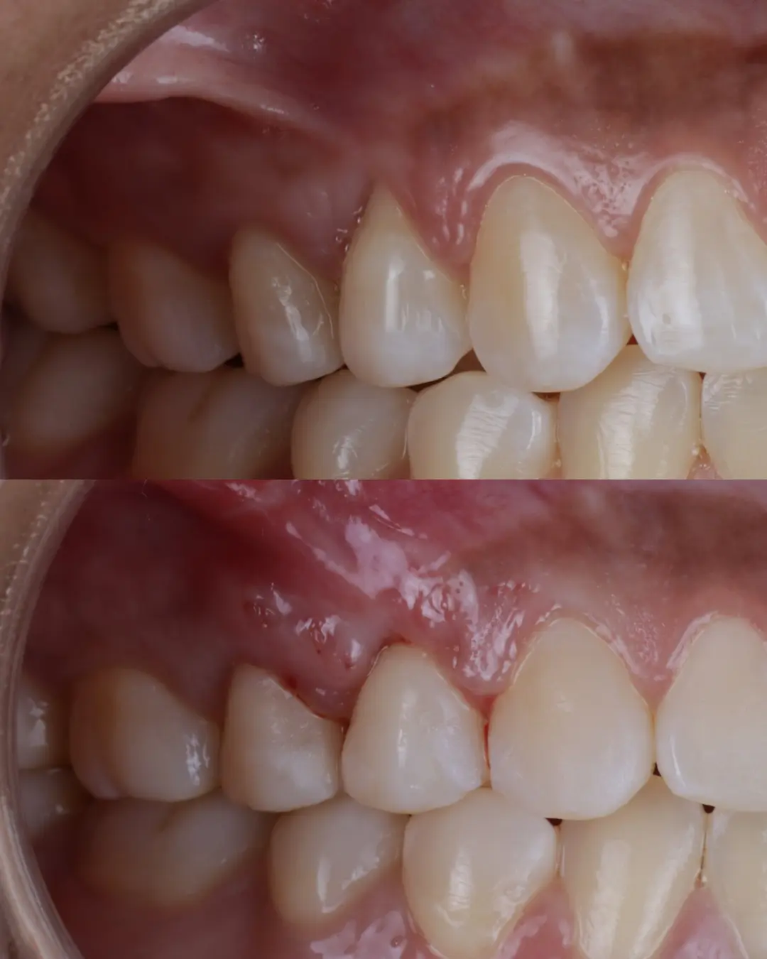 Comparação clínica antes e depois de enxerto gengival