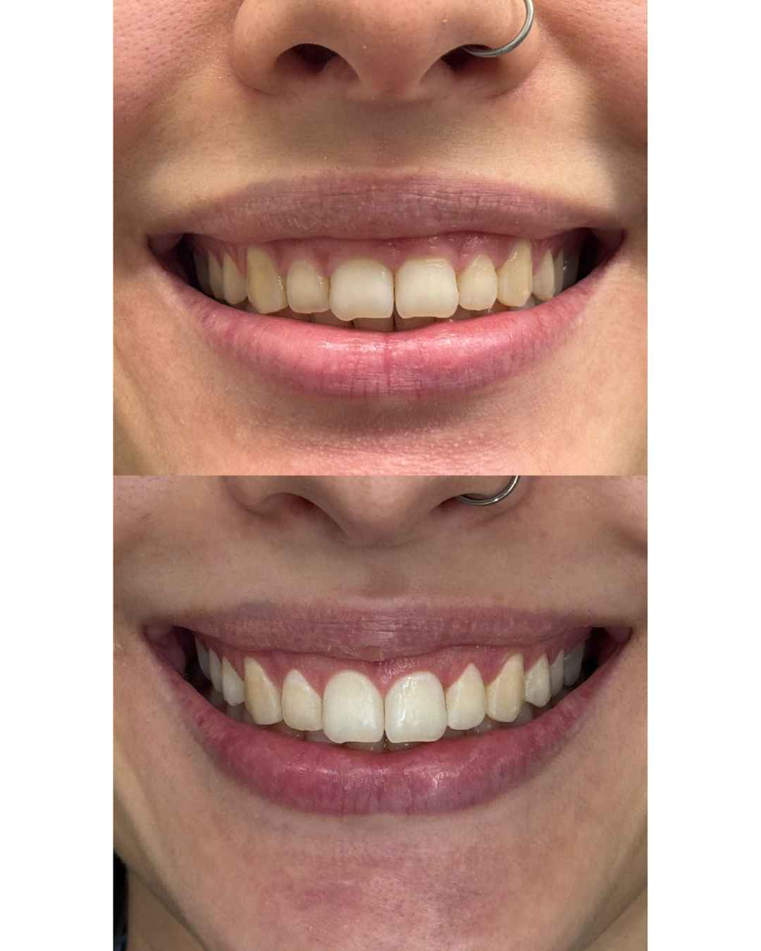 Antes e depois de tratamento estético do sorriso