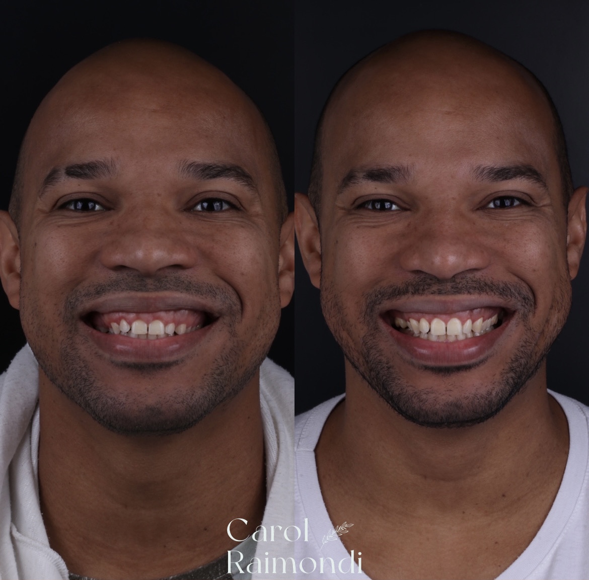 Retratos lado a lado de paciente após gengivoplastia