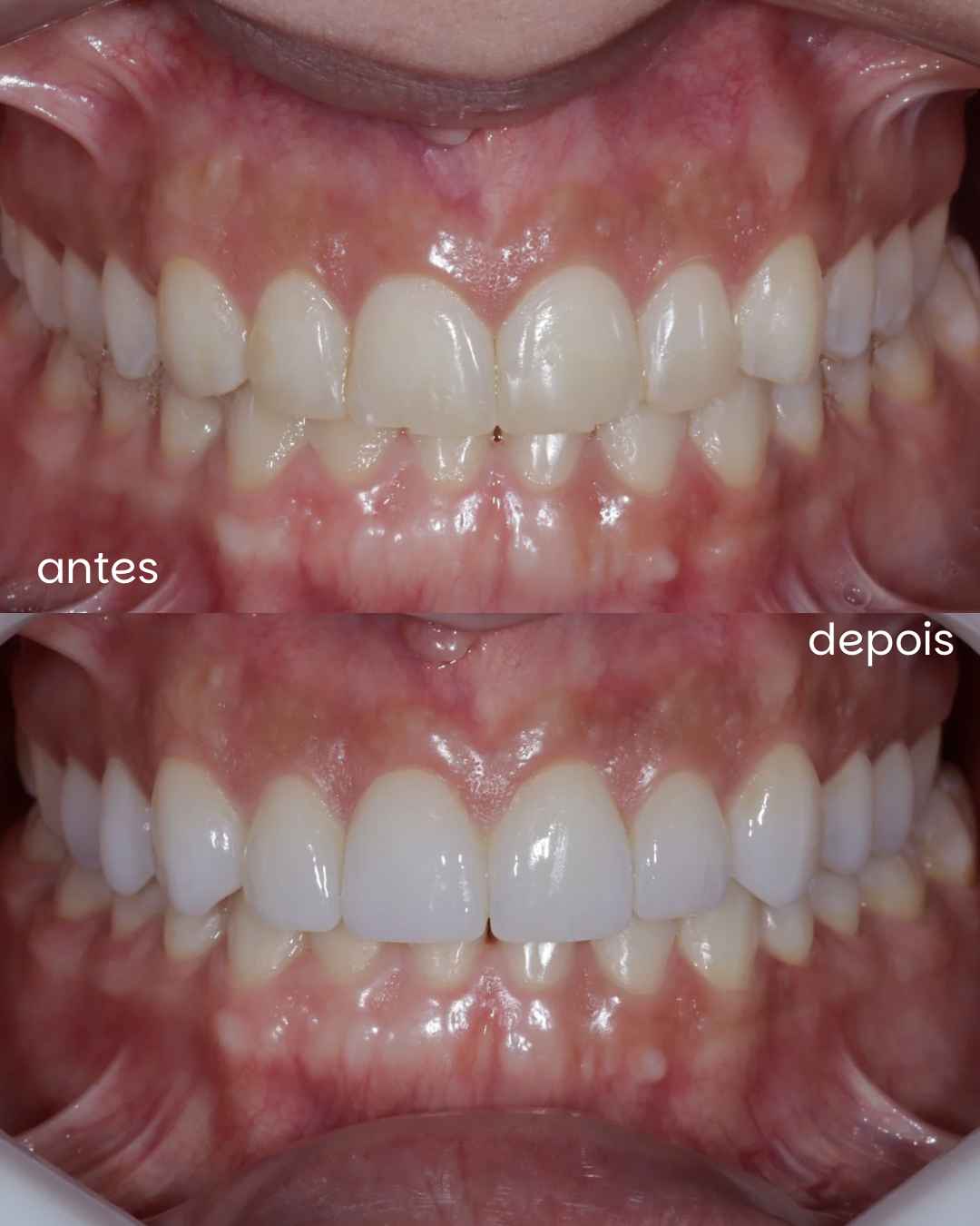 Antes e depois de tratamento periodontal e estético, com gengiva saudável