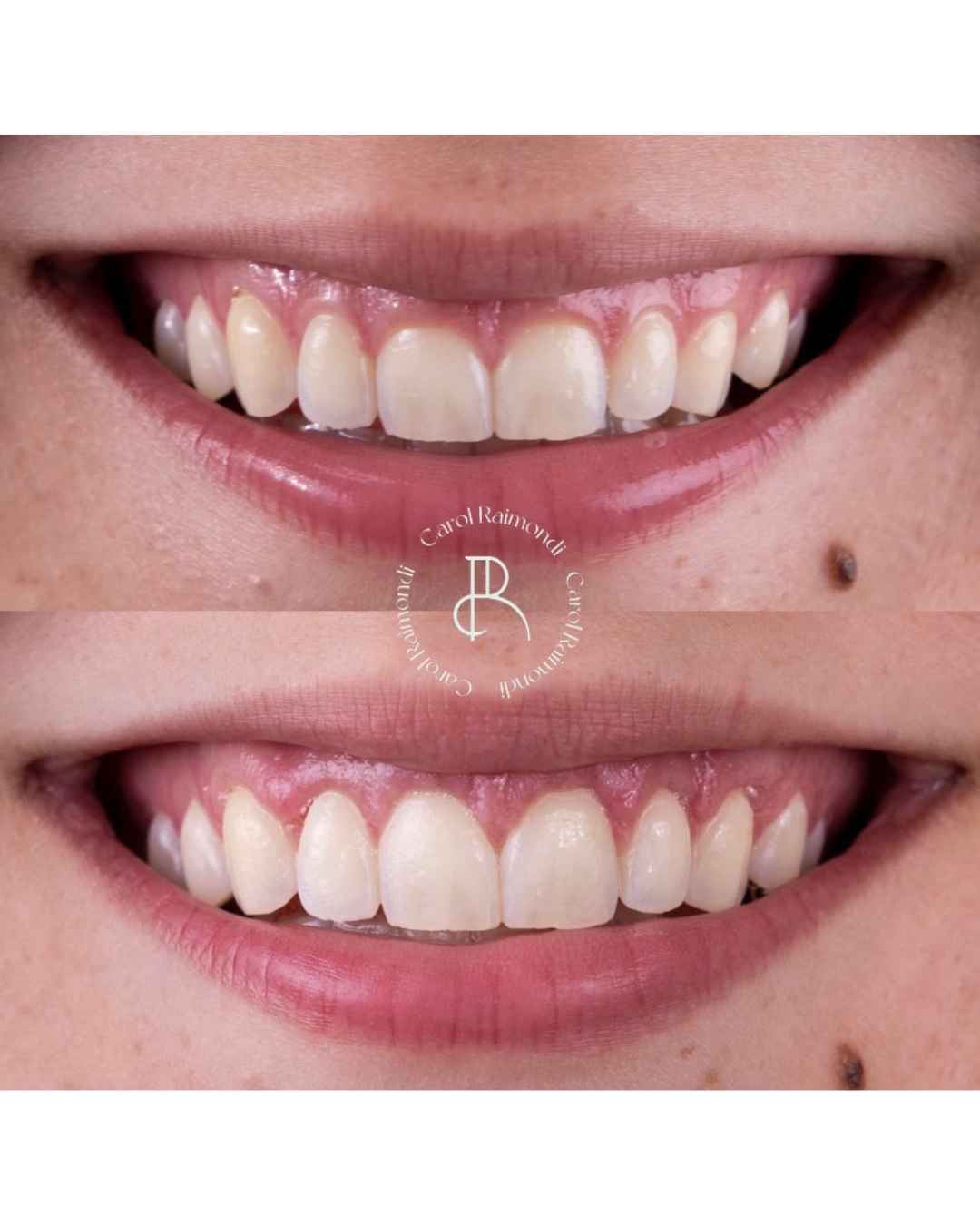 Antes e depois de gengivoplastia, com dentes mais proporcionais