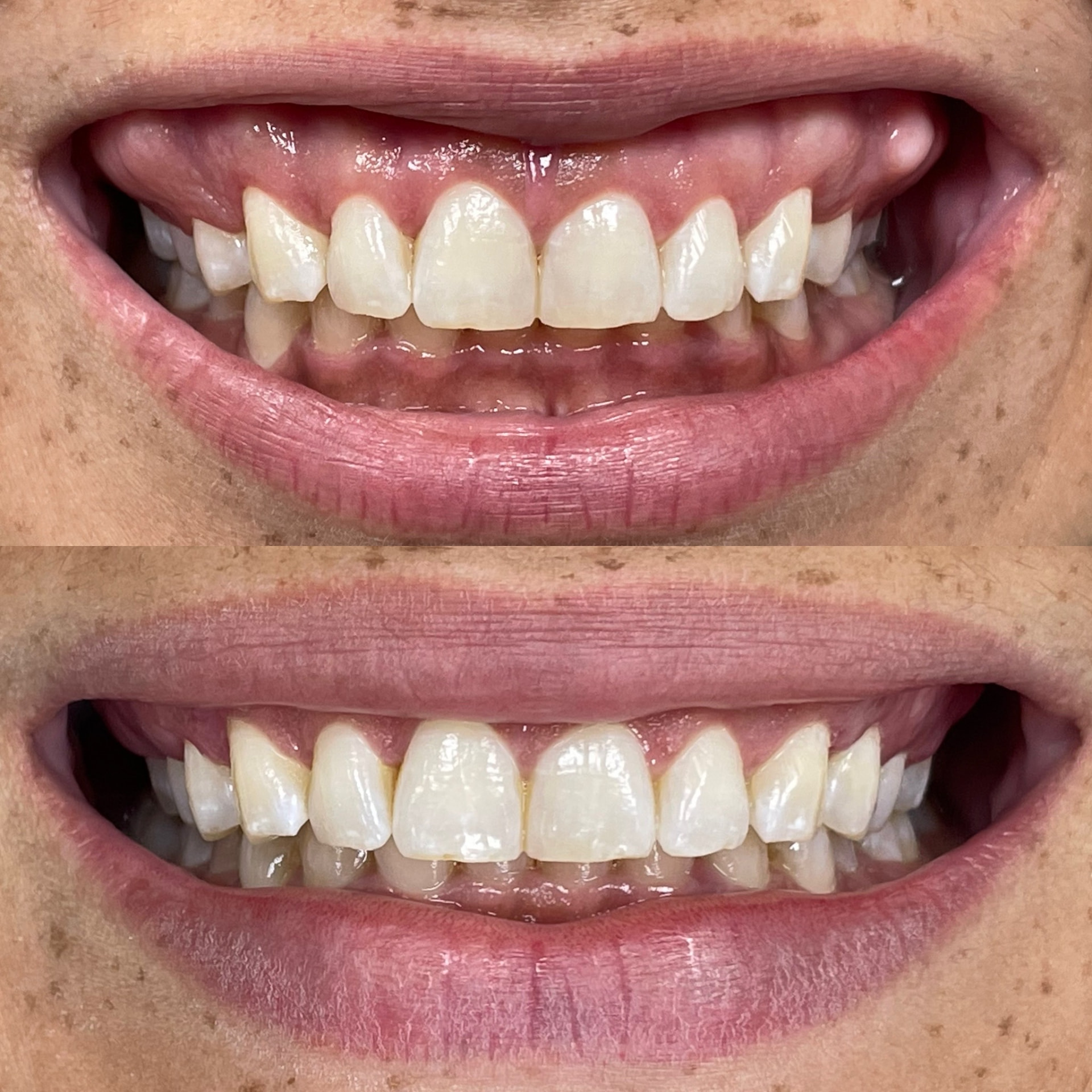 Comparação clínica antes e depois de gengivoplastia