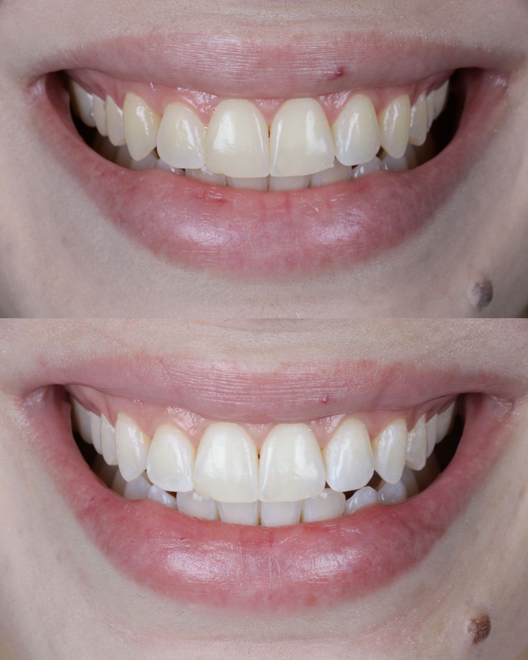 Comparação clínica antes e depois de clareamento dental
